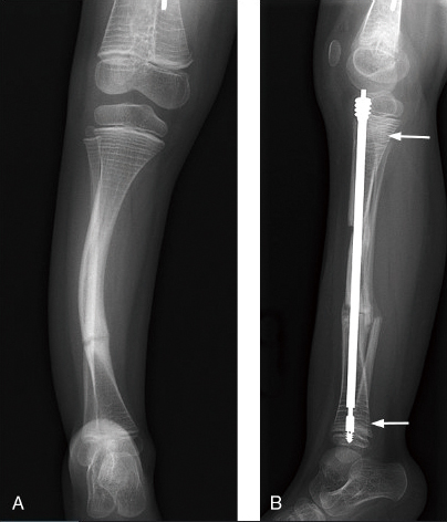 使用骨髓內釘治療脛骨骨折